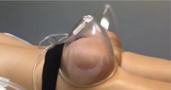 vacuum therapy machine utilisation